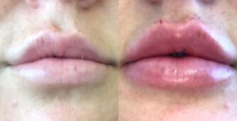Derma filler - lip treatment